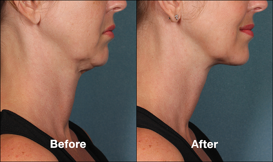 Kybella Before and After Female Treatment Photo